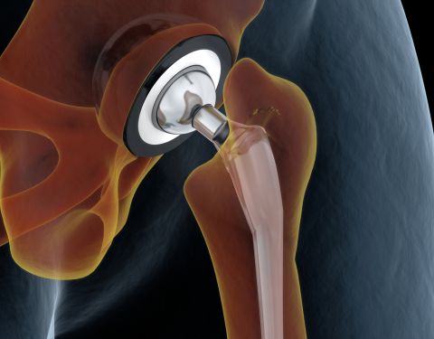 Complications of the hip replacement surgery