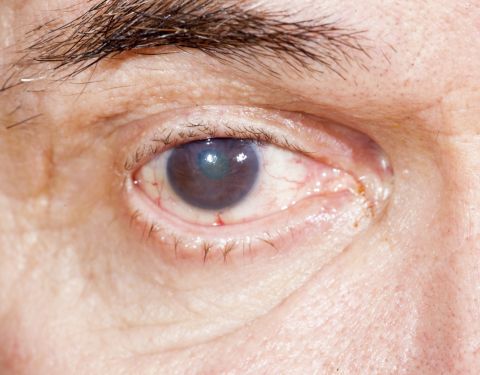 Cataract surgery or why cataract is not a verdict