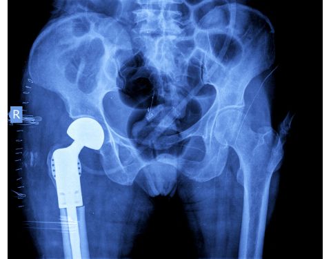 Orthopedics. Some reasons why Hip and Knee Replacement Surgeries should be performed in France