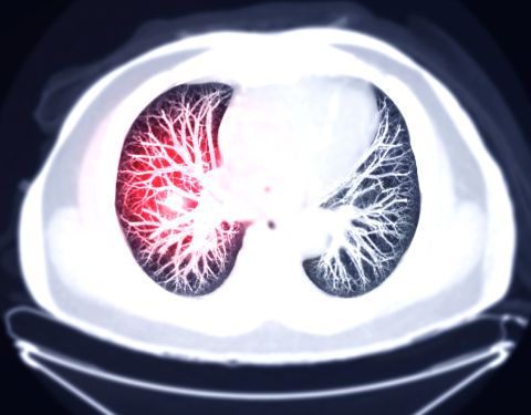 Lung Cancer Treatment in France
