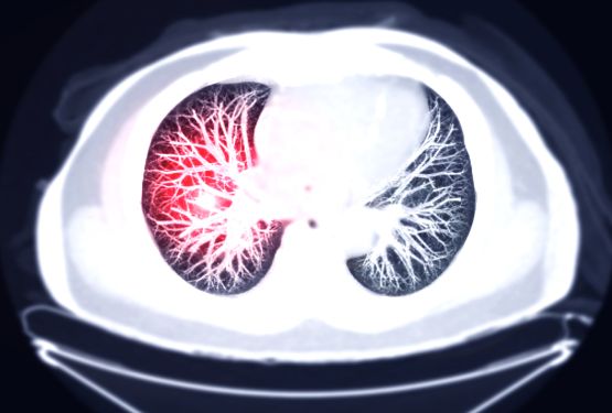 Lung Cancer Treatment in Europe 