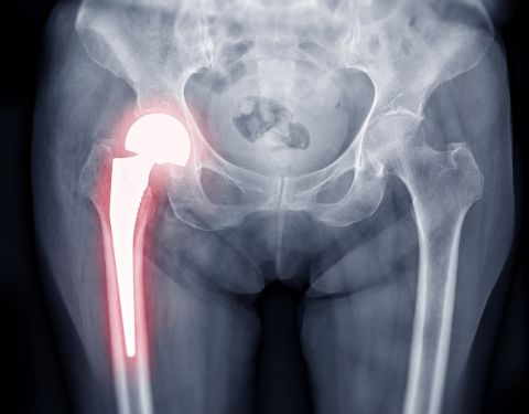 Séjour médical en France - La prothèse de hanche en France