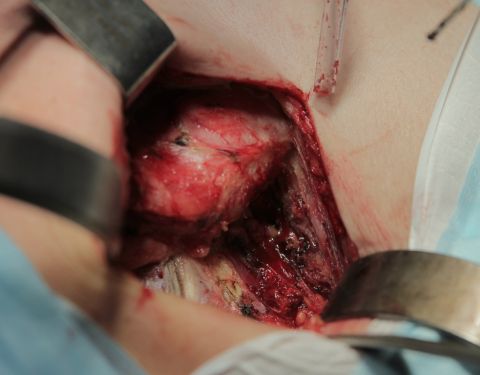 Эндопротезирование тазобедренного сустава, реабилитация после операции во Франции
